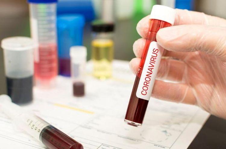 Bu gün Azərbaycanda 5811 nəfər koronavirus testindən keçdi<b style="color:red"></b>