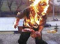 Özünü yandıran əlilin vəziyyəti orta ağırdır<b style="color:red"></b>