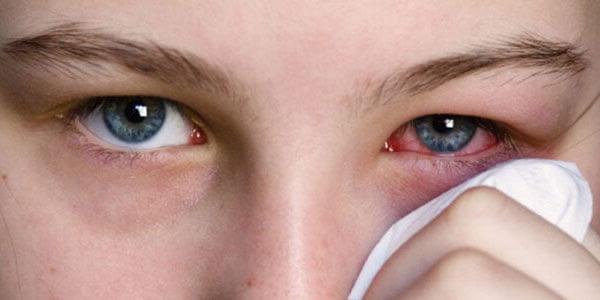 Uqandada epidemiya: "Qırmızı göz" xəstəliyi 7500 adamda görülüb