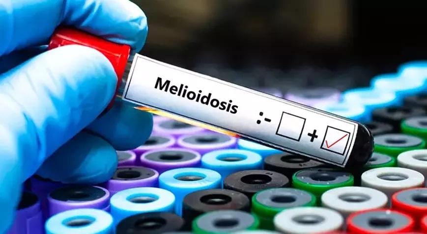 Avstraliyada melioidoz epidemiyasından ölənlərin sayı 31-ə çatıb