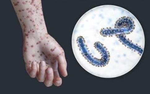 Efiopiyada ölümcül epidemiyaya son qoyuldu