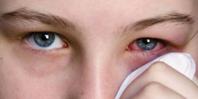 Uqandada epidemiya: "Qırmızı göz" xəstəliyi 7500 adamda görülüb