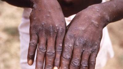 Zimbabve və Zambiyada ilk meymun çiçəyi halları aşkarlanıb